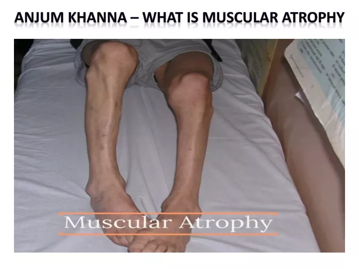 anjum khanna what is muscular atrophy