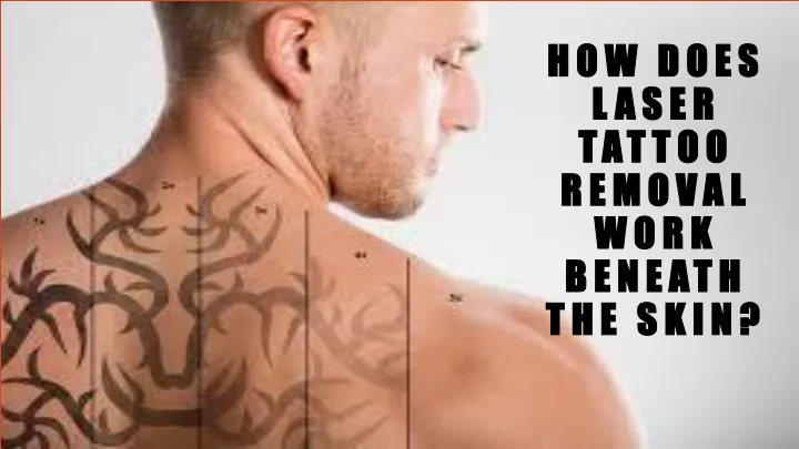 how does laser tattoo removal work beneath the skin