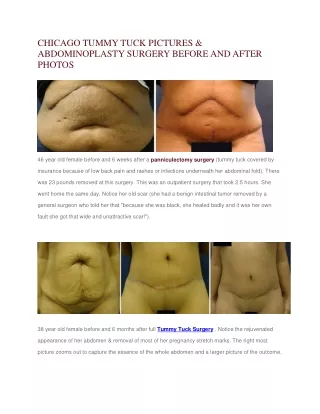 Chicago Tummy Tuck Pictures & Abdominoplasty Surgery Before And After Photos