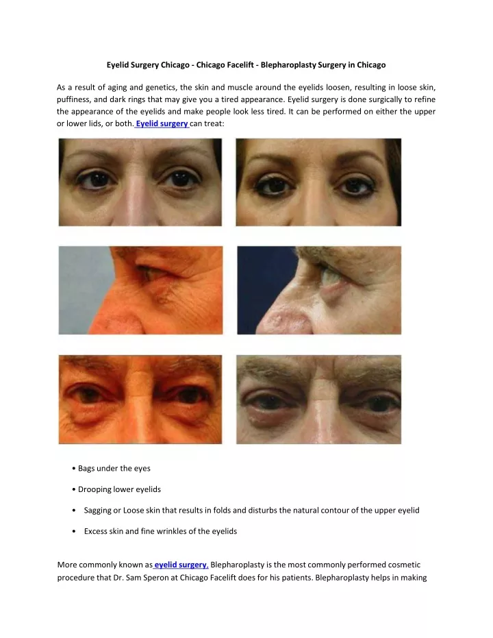 eyelid surgery chicago chicago facelift