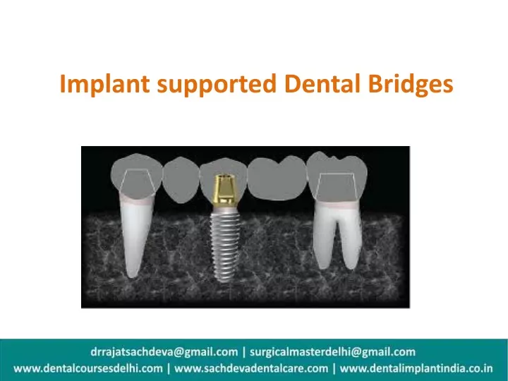 implant supported dental bridges
