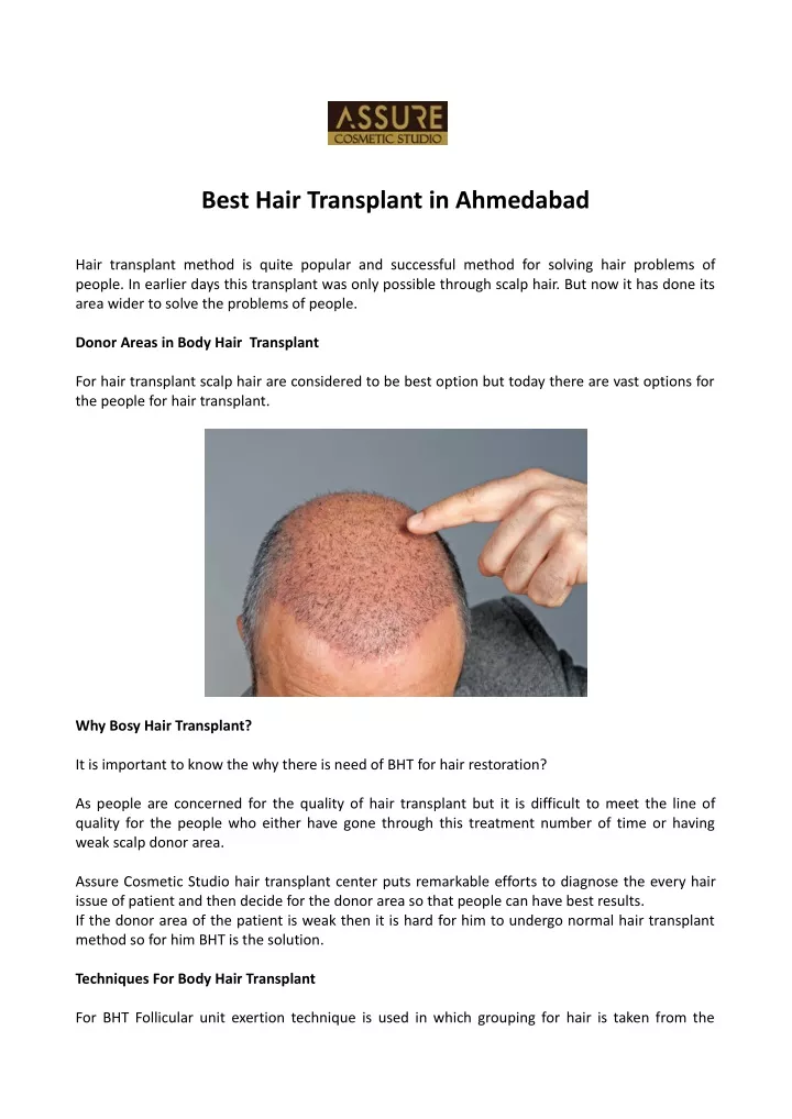 best hair transplant in ahmedabad