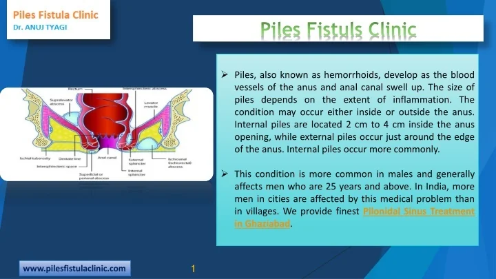 PPT - Get Best Treatment for Piles: Piles Fistuls Clinic PowerPoint ...