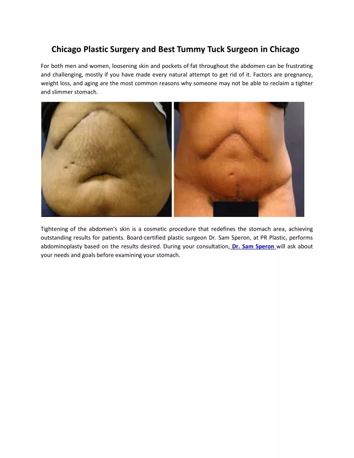 chicago plastic surgery and best tummy tuck