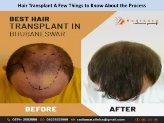 Hair Transplant A Few Things to Know About the Process