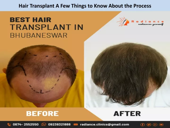 hair transplant a few things to know about the process