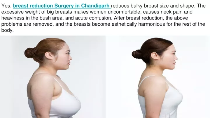 yes breast reduction surgery in chandigarh