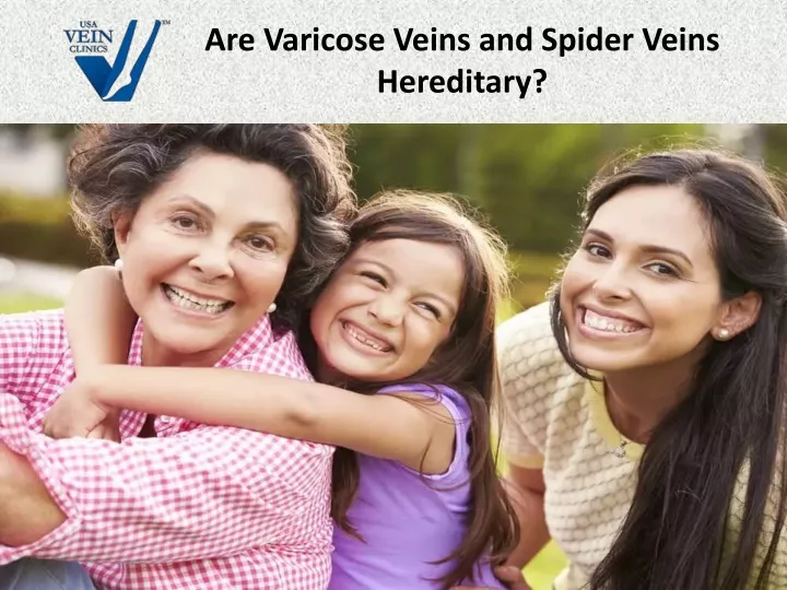 are varicose veins and spider veins hereditary