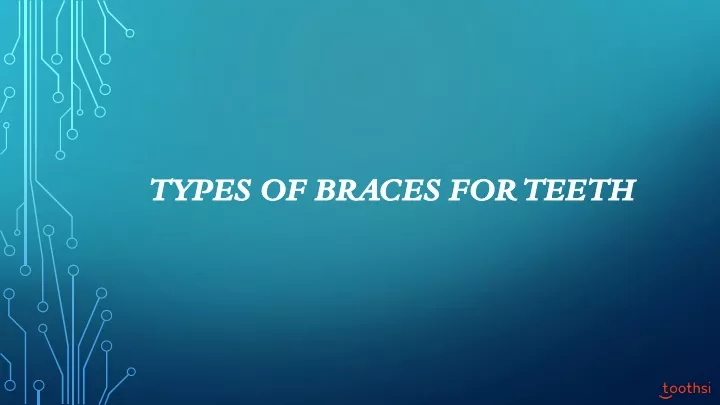 types of braces for teeth