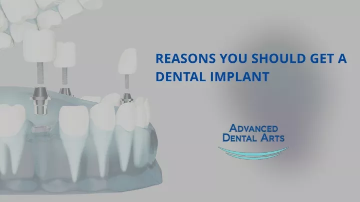reasons you should get a dental implant