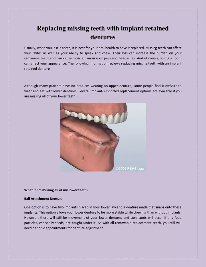 replacing missing teeth with implant retained