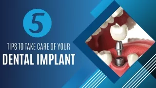 5 Tips to Take Care of Your Dental Implant