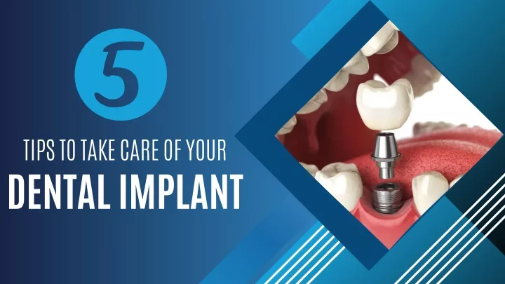 tips to take care of your dental implant