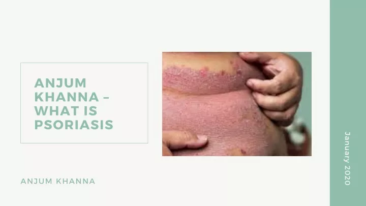 anjum khanna what is psoriasis