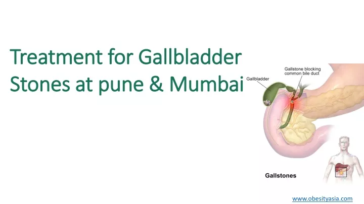 treatment for gallbladder stones at pune mumbai