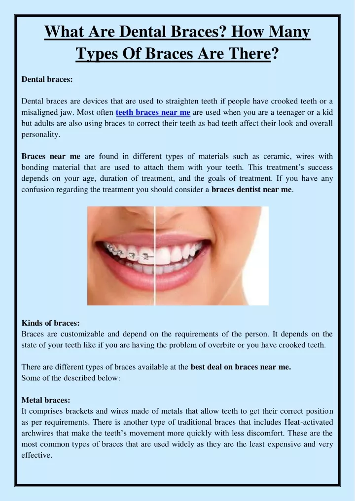 what are dental braces how many types of braces