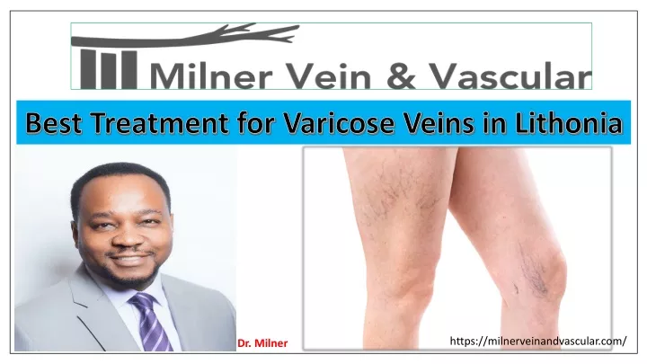 best treatment for varicose veins in lithonia