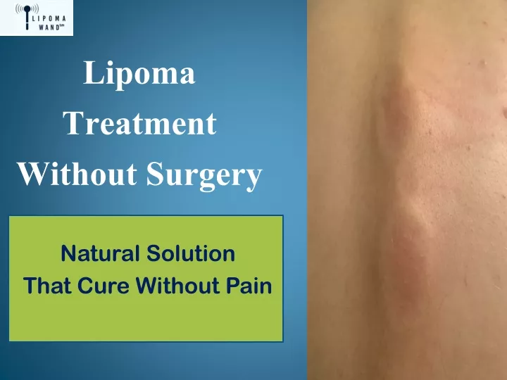 lipoma treatment without surgery