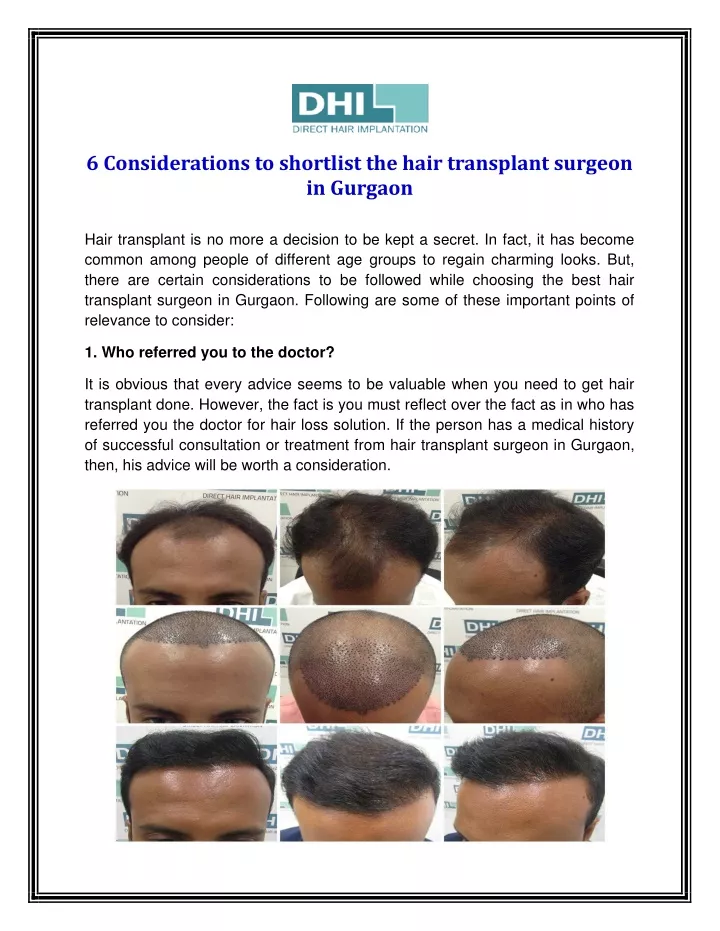 6 considerations to shortlist the hair transplant