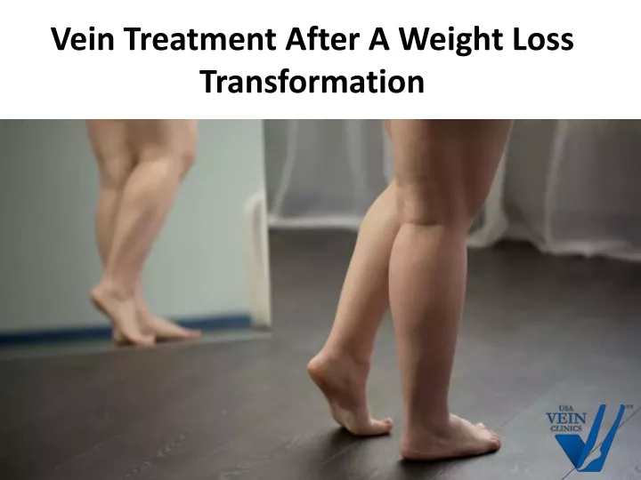 vein treatment after a weight loss transformation