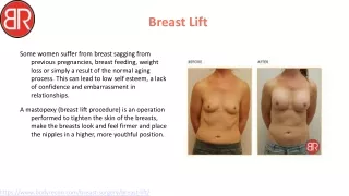 Best Breast Lift Surgeons Of Australia - Body Recon