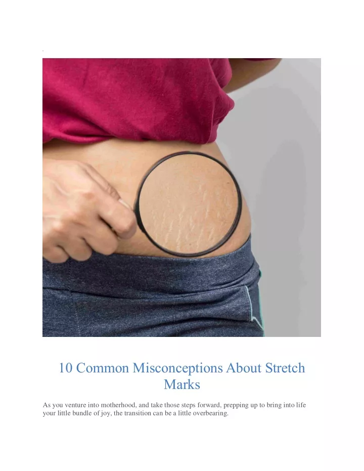 10 common misconceptions about stretch marks
