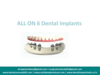All on 6 Dental Implants