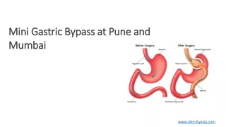 Mini Gastric BypassSingle anastomosis Gastric By-pass at Pune and Mumbai