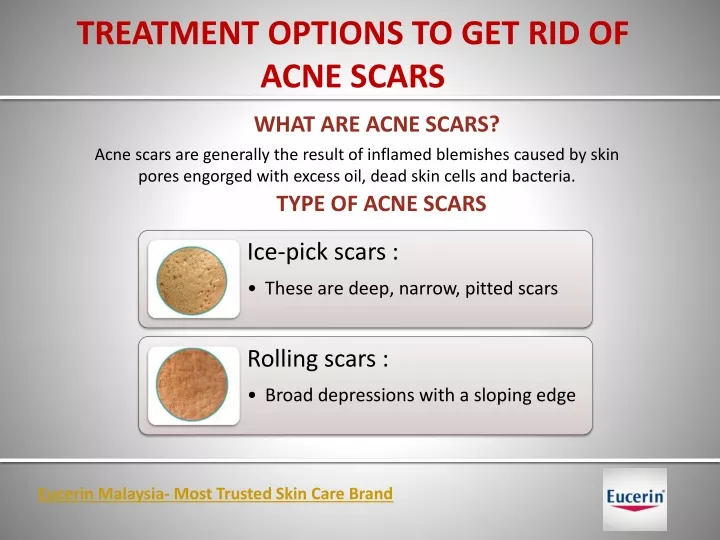 treatment options to get rid of acne scars