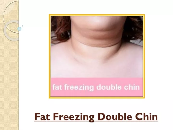 fat freezing double chin