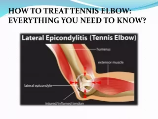 HOW TO TREAT TENNIS ELBOW: EVERYTHING YOU NEED TO KNOW?