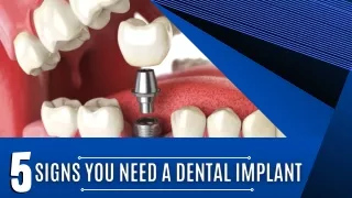 5 Signs You Need a Dental Implant