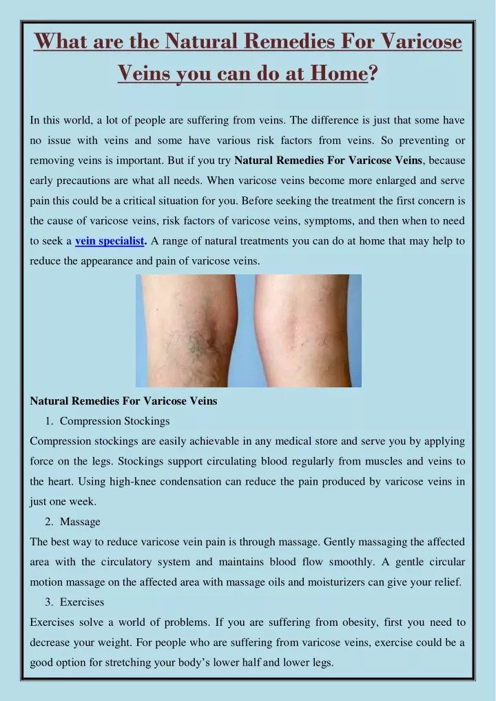 what are the natural remedies for varicose veins