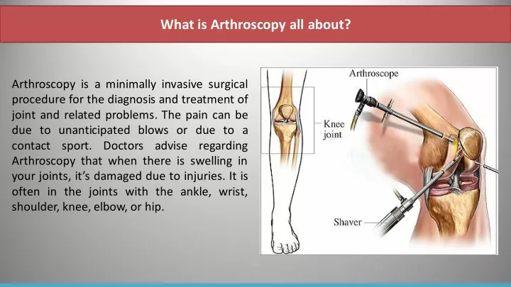 Ppt What Is Arthroscopy All About Powerpoint Presentation Free Download Id10371798 2565