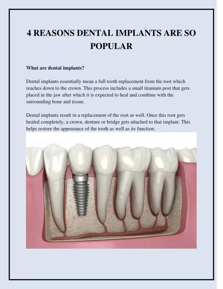 4 reasons dental implants are so popular