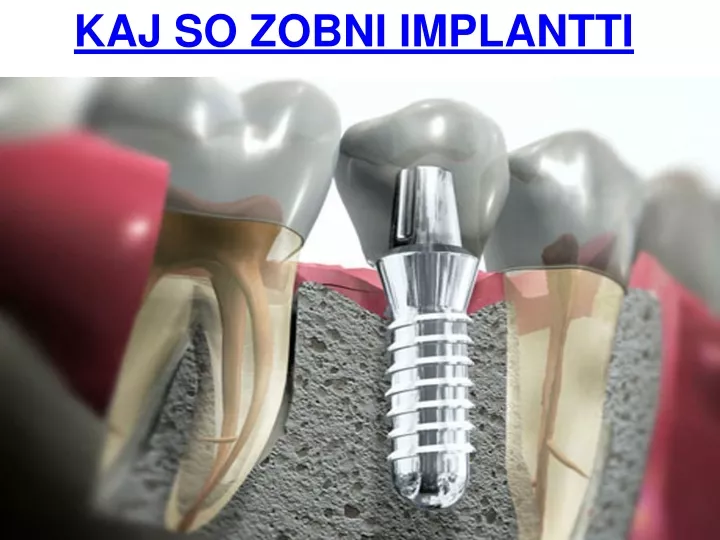 kaj so zobni implantti