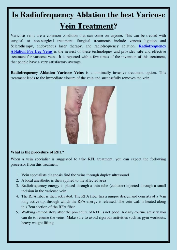 is radiofrequency ablation the best varicose vein