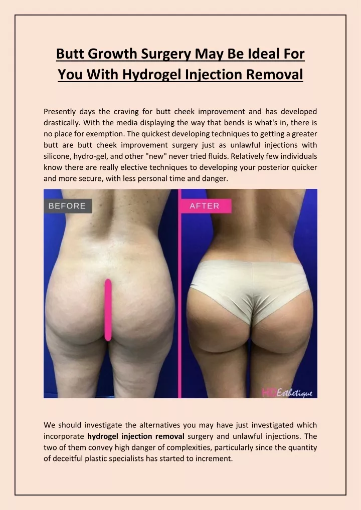 butt growth surgery may be ideal for you with