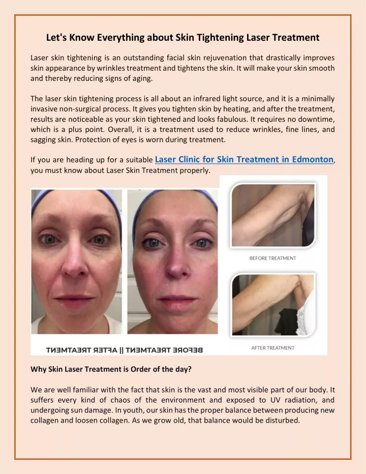 let s know everything about skin tightening laser