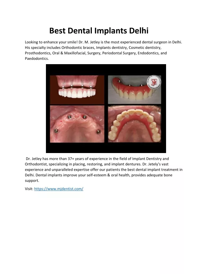 best dental implants delhi