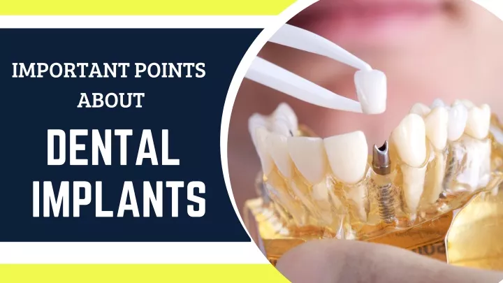 important points about dental implants