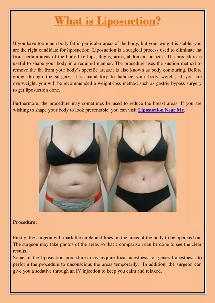 what is liposuction