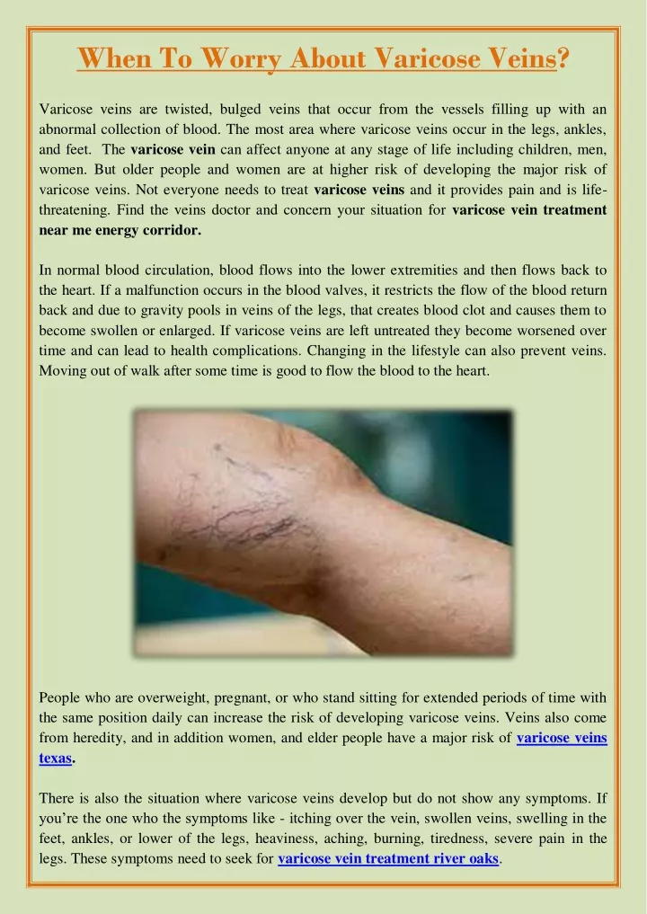 when to worry about varicose veins