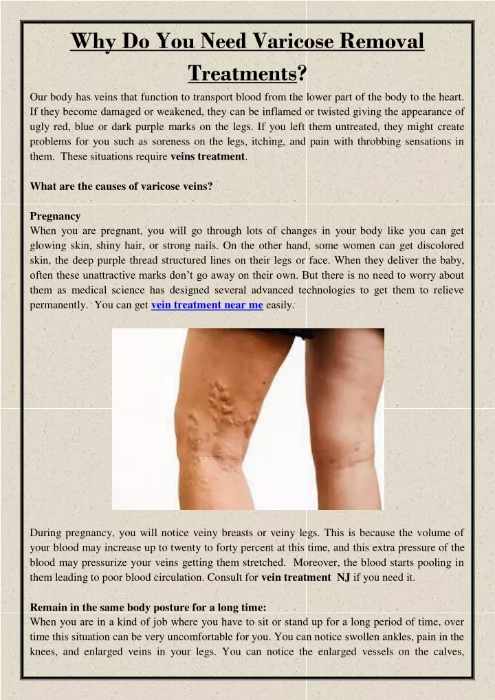 why do you need varicose removal treatments
