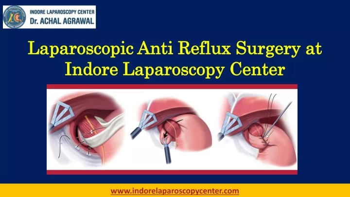 laparoscopic anti reflux surgery at indore