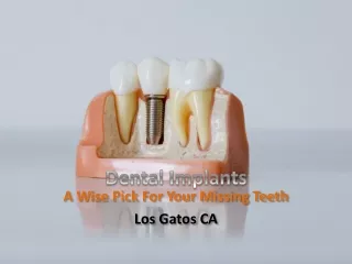 Dental Implants - A Wise Pick For Your Missing Teeth | Los Gatos California