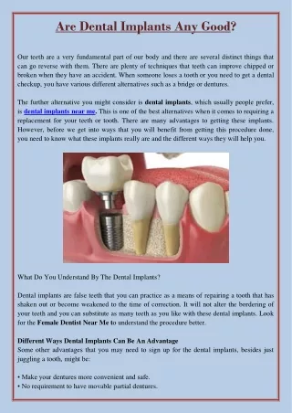 are dental implants any good