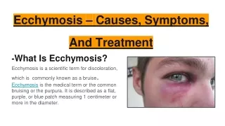 Ecchymosis – Causes, Symptoms, And Treatment