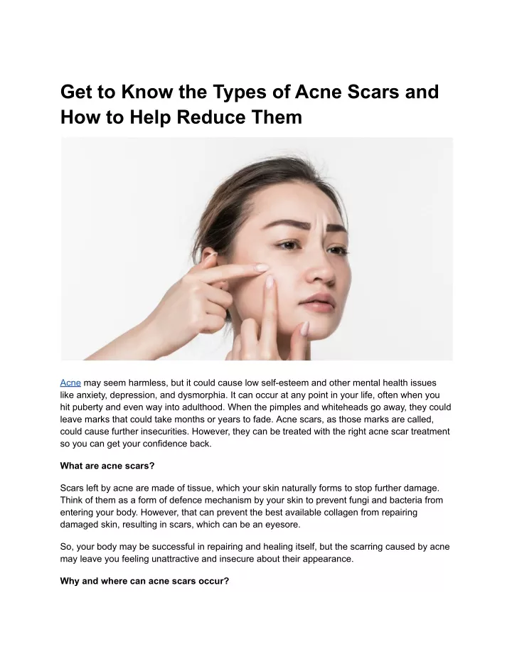 get to know the types of acne scars
