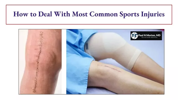 how to deal with most common sports injuries